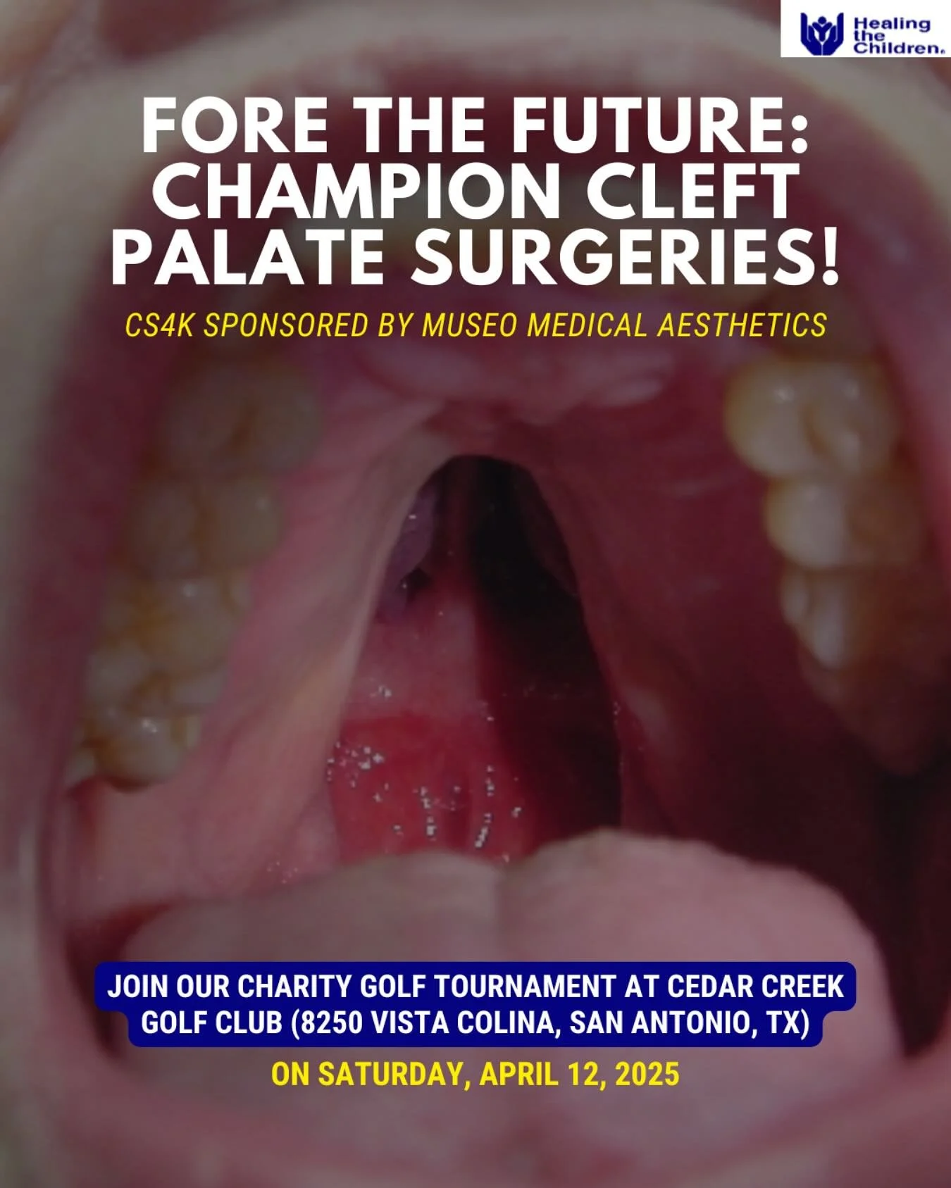 Join us for a charity golf tournament at Cedar Creek Golf Club in San Antonio, TX, on Saturday, April 12, 2025! ⛳ Every swing helps provide life-changing cleft palate surgeries for children in need. 💙

📍 Cedar Creek Golf Club (8250 Vista Colina, Sa