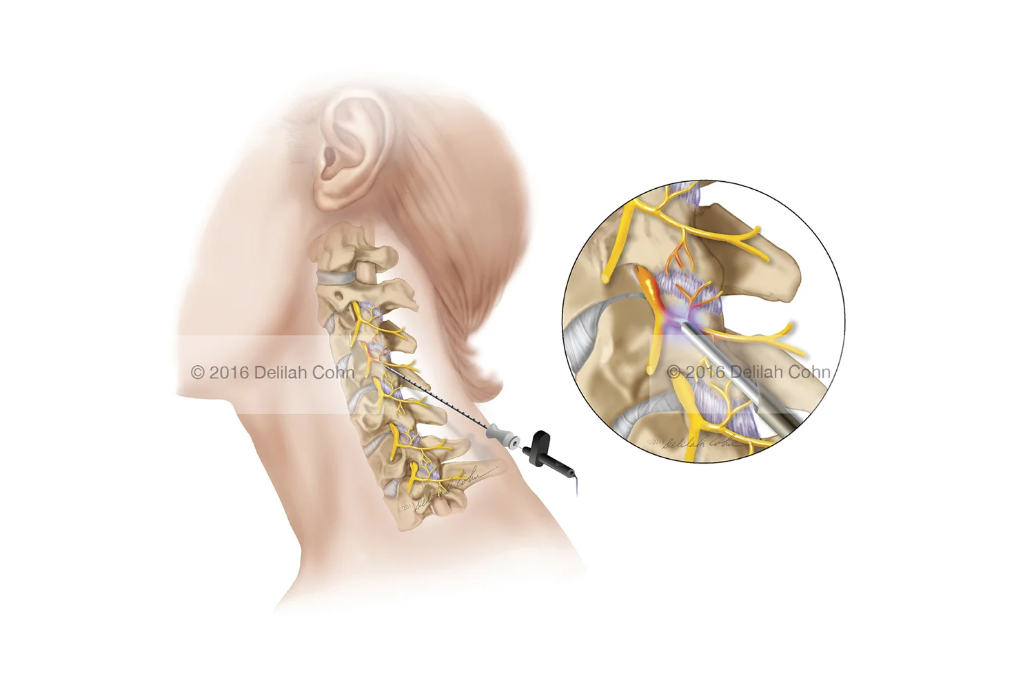 Cervical Facet Syndrome — Radio-Frequency Ablation (RFA)