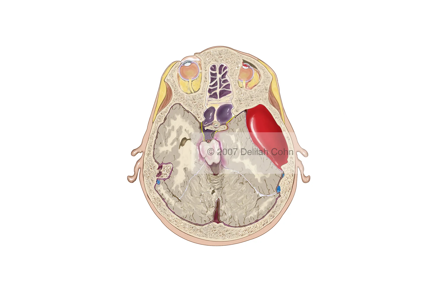 Epidural Hematoma Causing Midline Shift