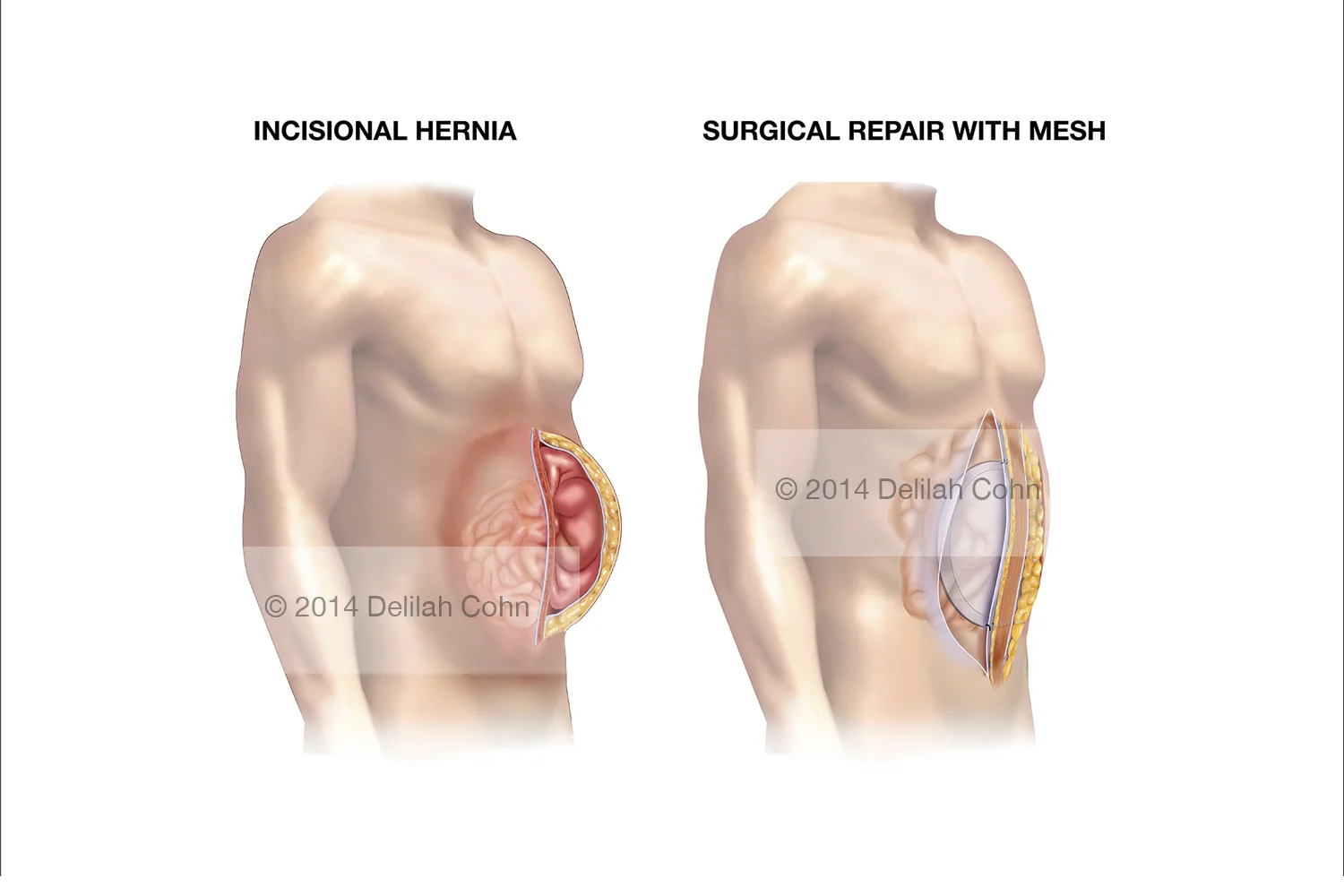 Incisional abdominal Hernia and Mesh Repair