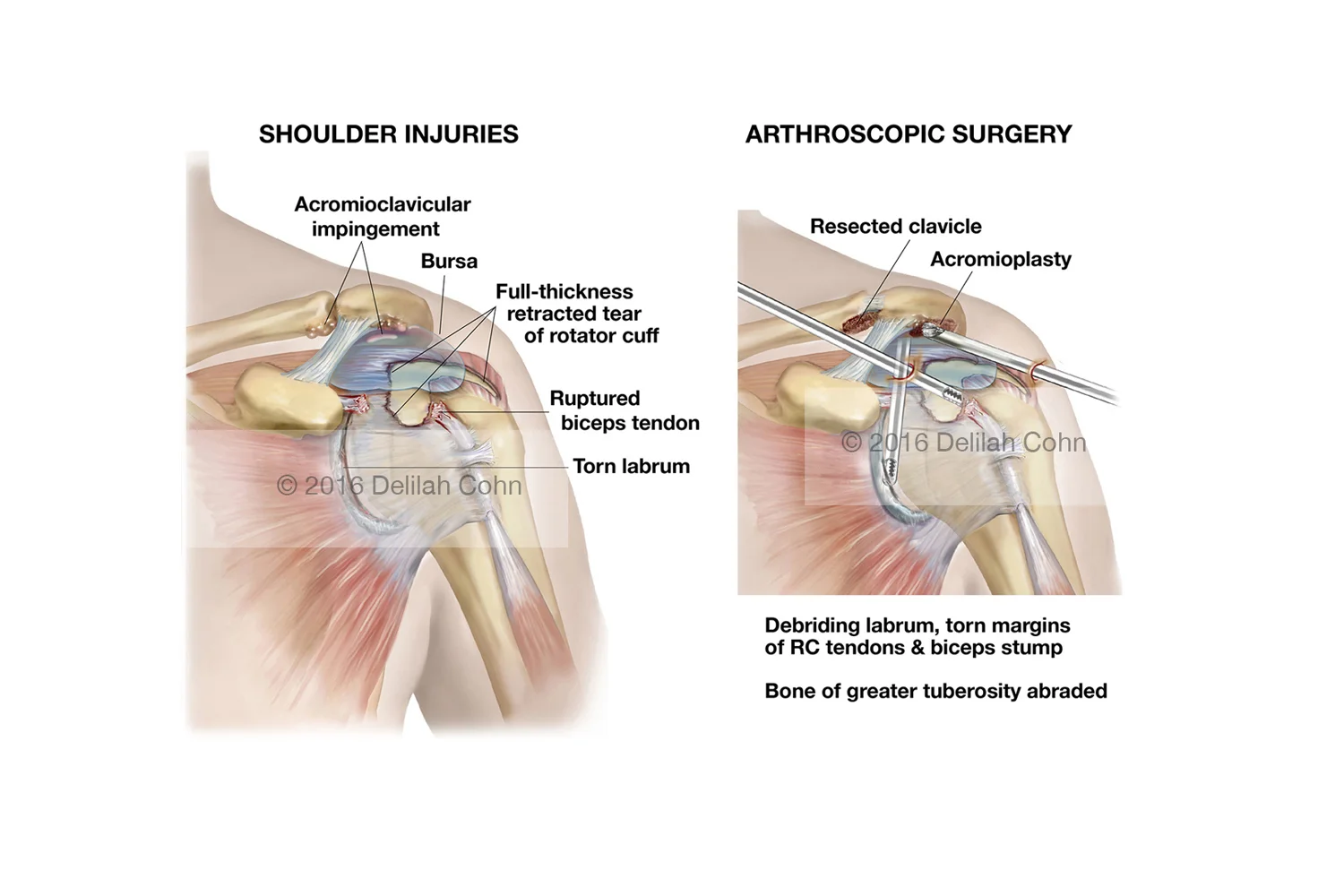 Shoulder injuries and Arthroscopic Surgical Repairs