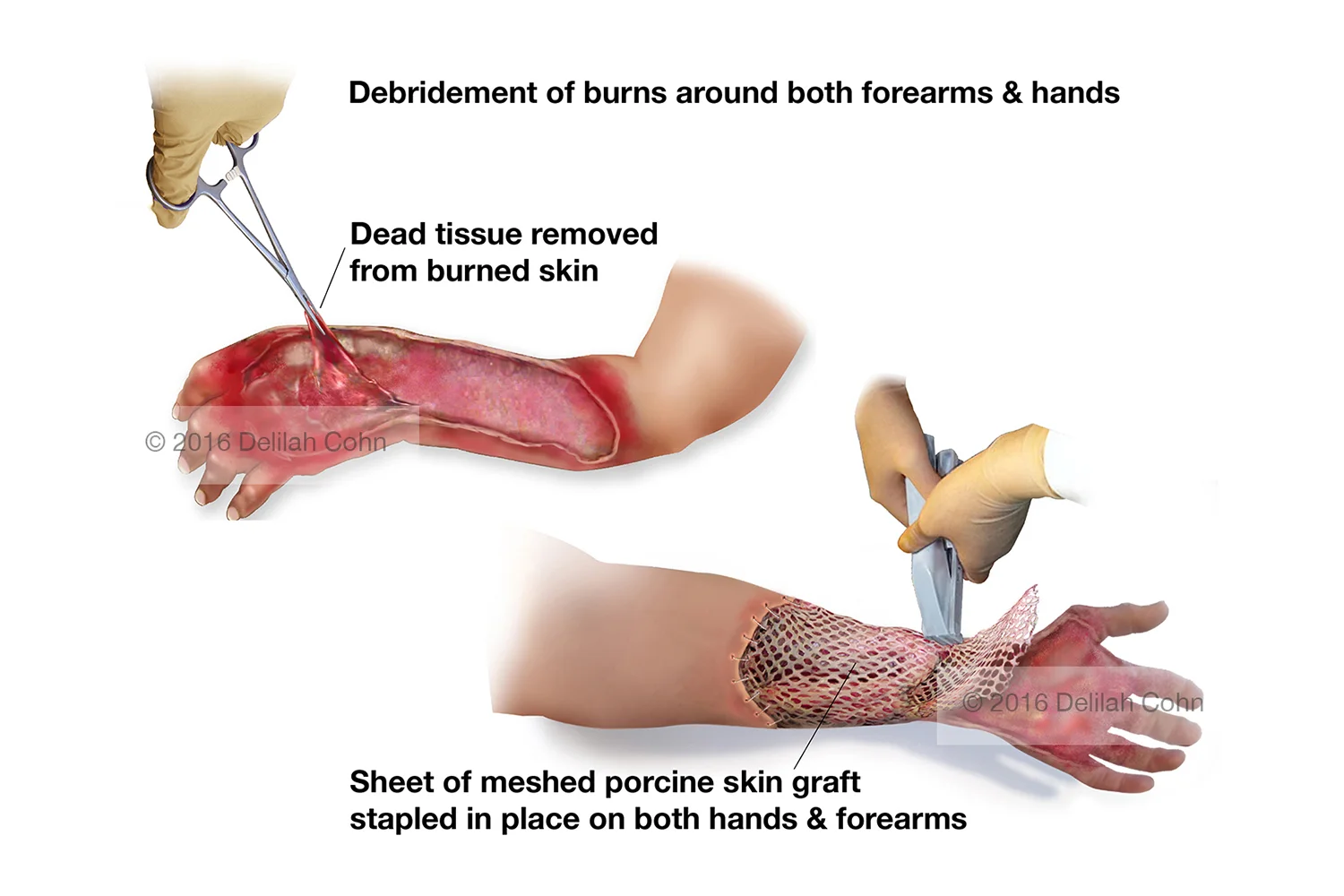 Burns: Debridement and Skin Grafts