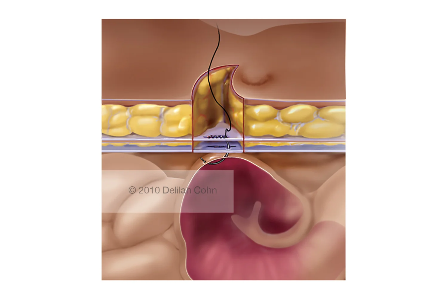Bowel Perforation during Abdominal Wall Closure