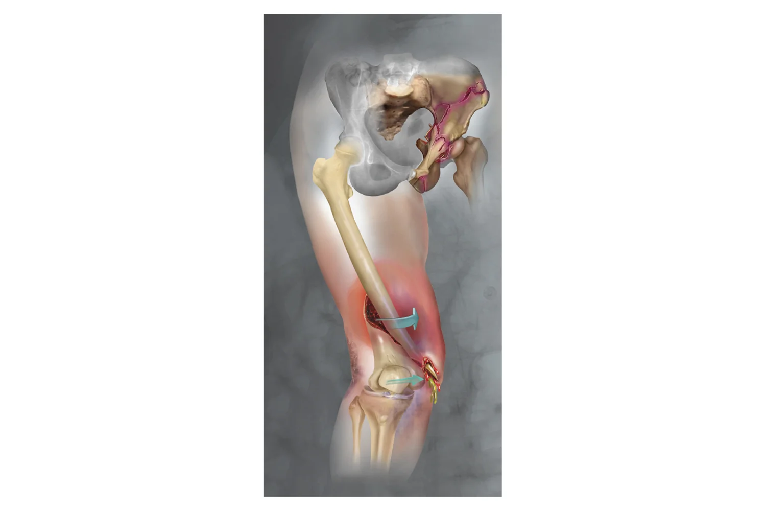Pelvic Fractures and a Spiral Femur fracture