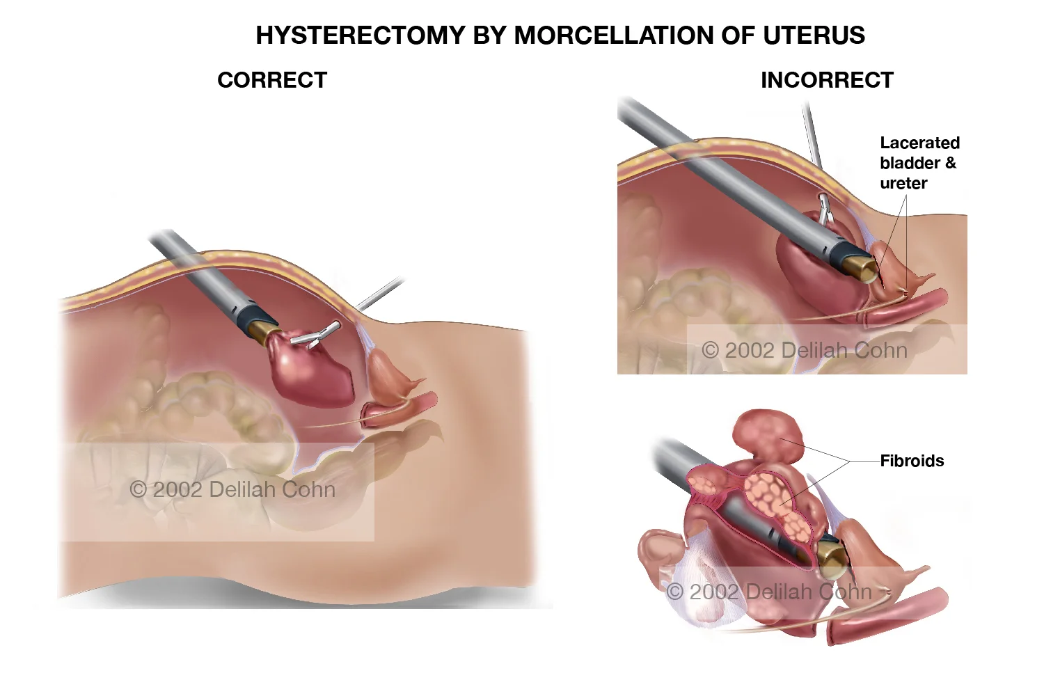 Hysterectomy by Morcellation of the Uterus