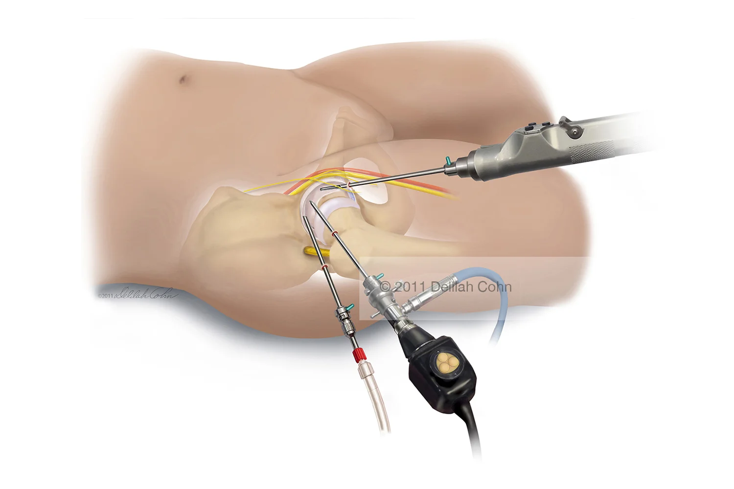 Hip Arthroscopy
