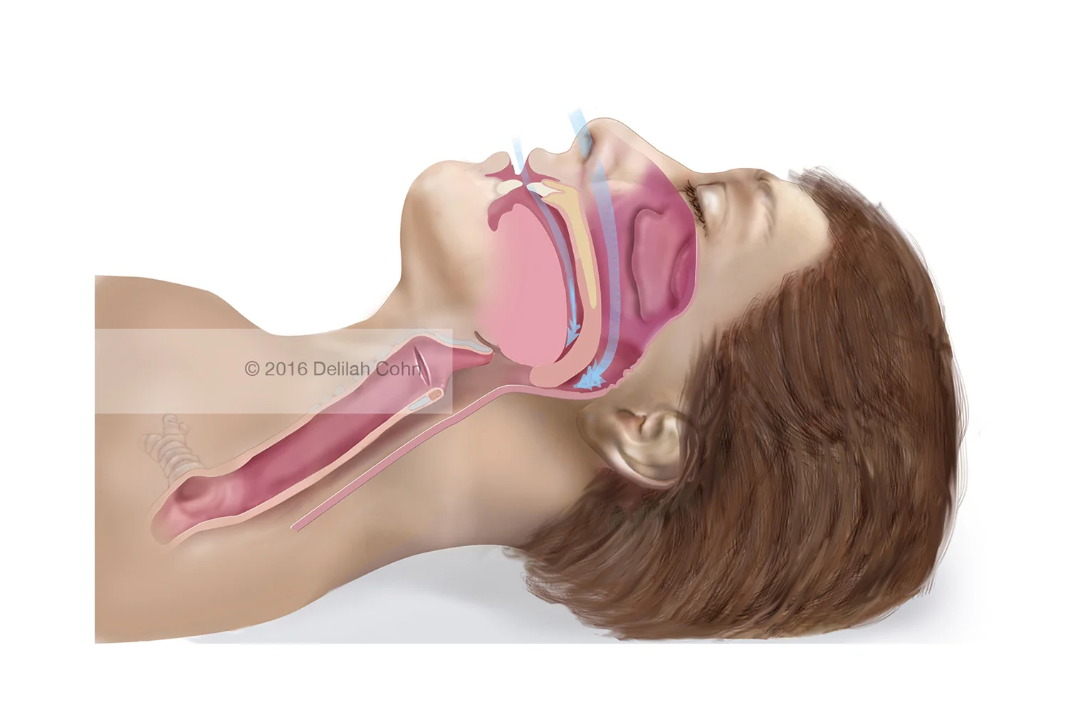 Obstructive Sleep Apnea