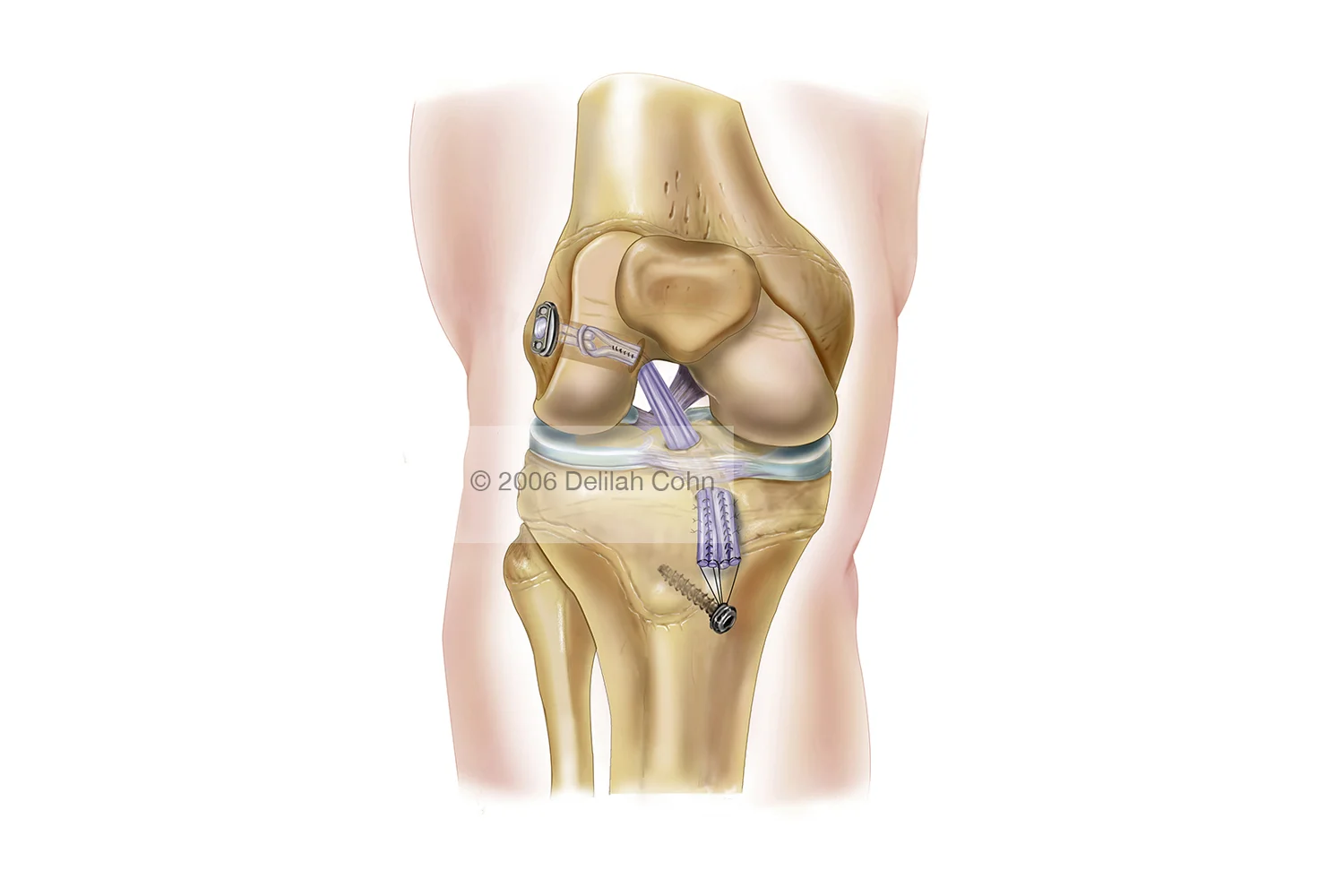 ACL Repair