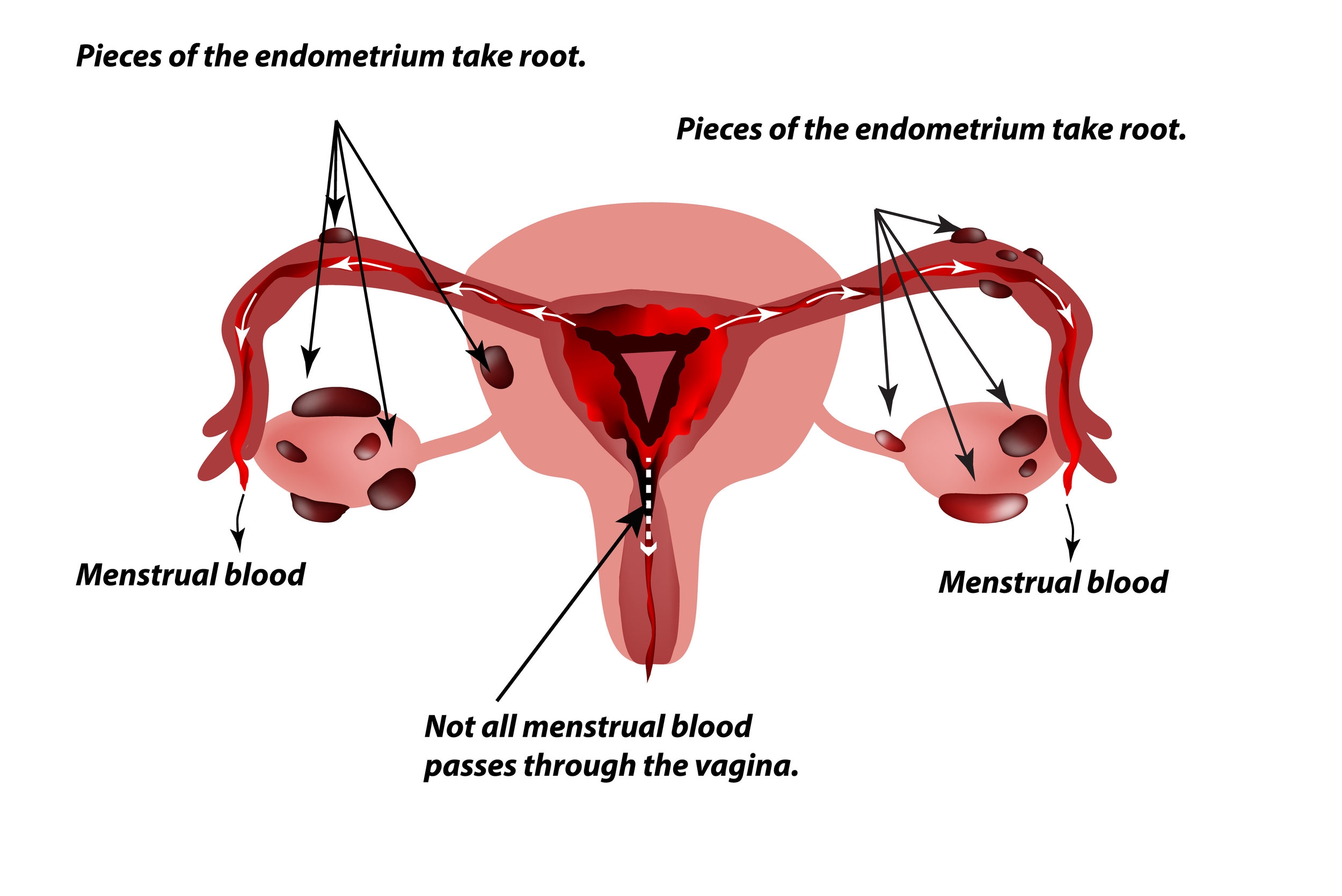 Endometriosis assessment — Women's Ultrasound Specialists Melbourne