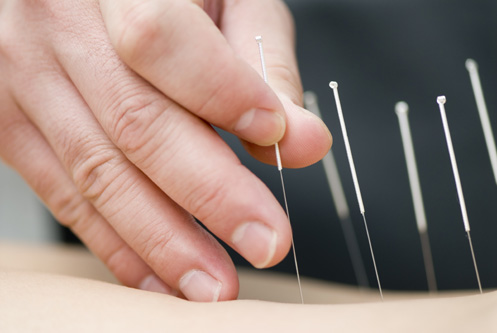 Dry Needling Trigger Point Accupuncture