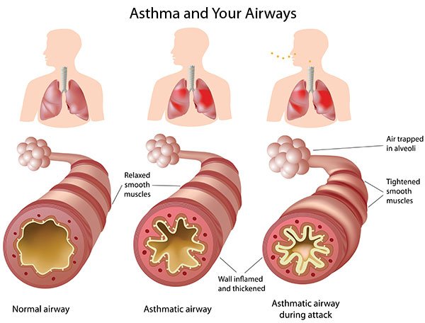 asthma-airways_lg.jpg