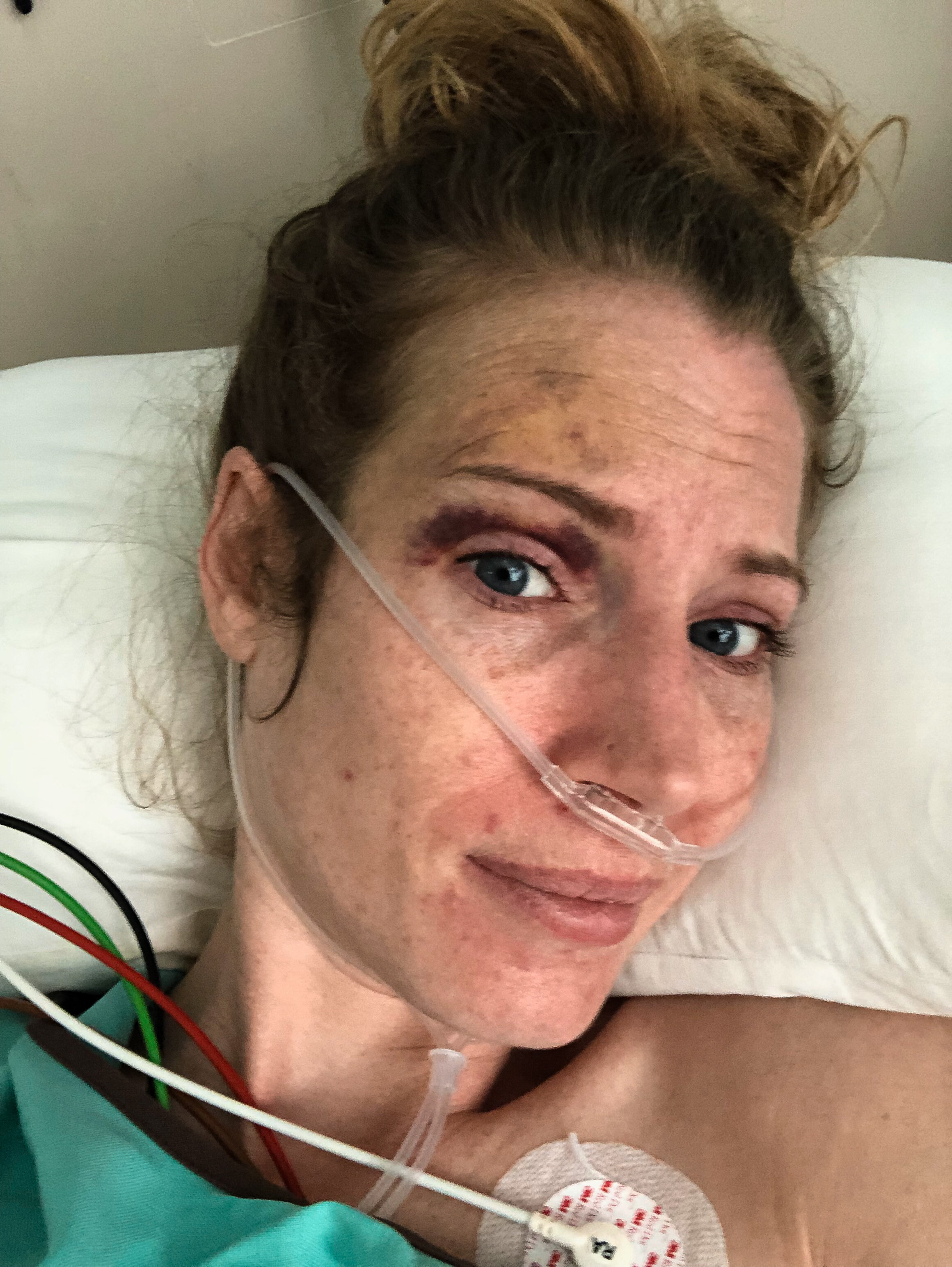 Leya in ICU, Bangkok Thailand, May 2019.