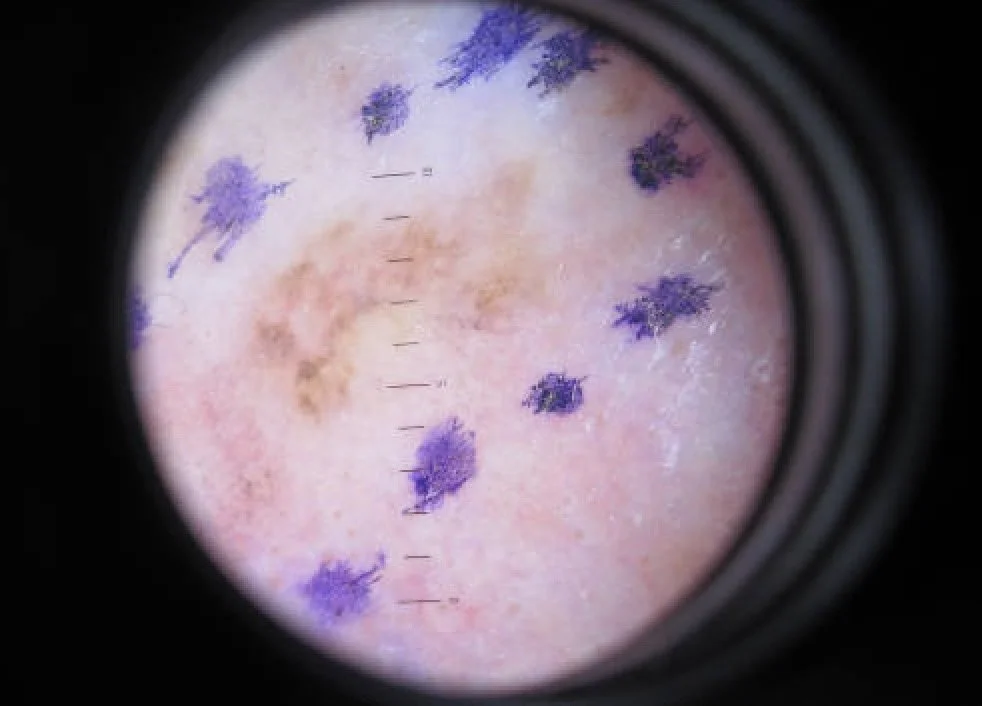 Building DeepSkin: a low-cost state-of-the-art digital dermatoscope