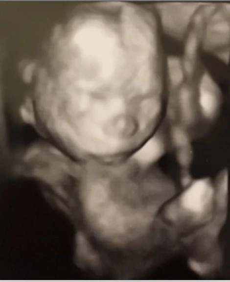 Anna Kooiman Baby Boy 20 Weeks Scan Sept 2017.jpg