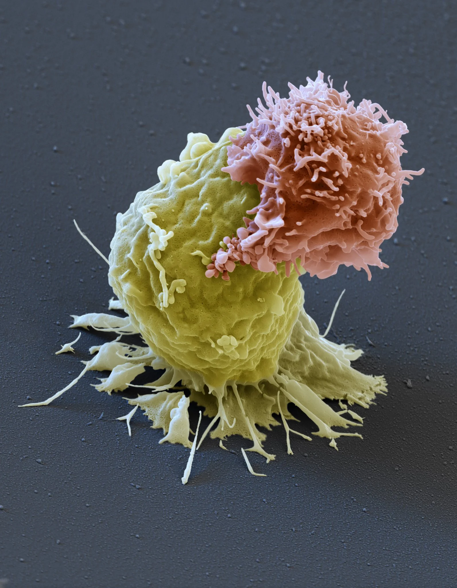 Photo: Cancer fighting T-cell attacking Leukemia cell from New York Times; Eye of Science, via Science Source