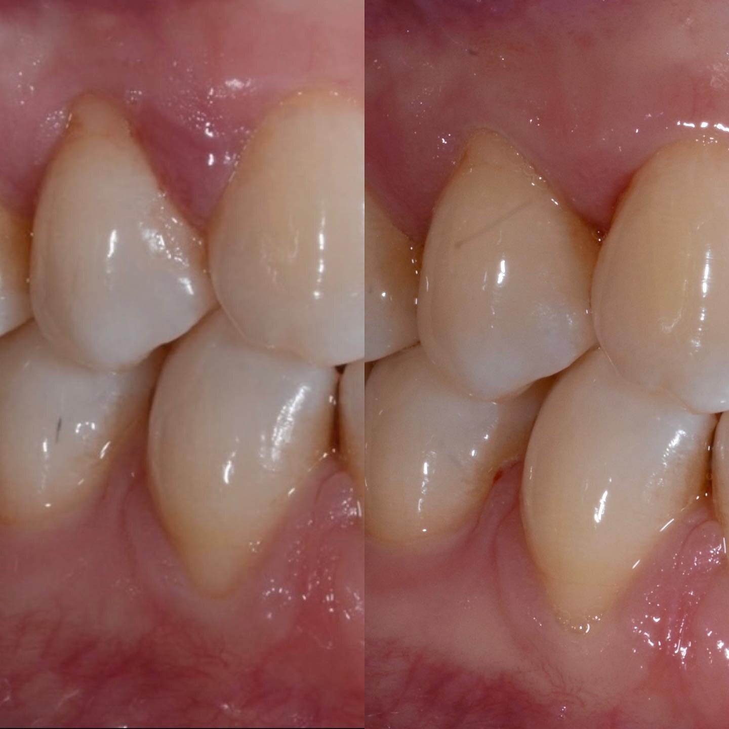 SRP with Perioscopy &amp; CTG

This young patient was referred to us for localized deep pockets and recession.

#5/6 was red, inflamed and probing at 6 mm. During scaling &amp; root planing with perioscopy, hypercementation was seen with the scope an