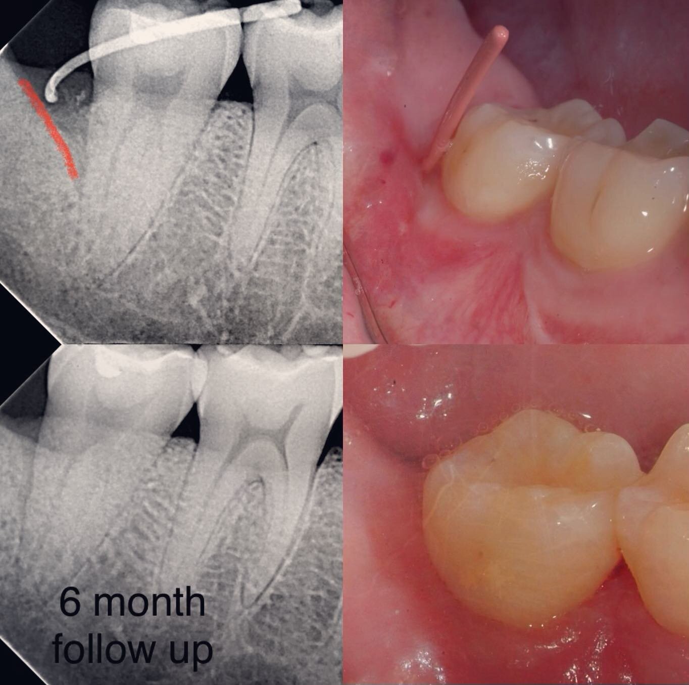 This patient was referred for localized deep probing, a bony crater and inflammation of #31  distal following removal of an impacted #32 (wisdom tooth). At the time of the exam, a draining sinus tract was noted - see photo and x-ray with gutta percha