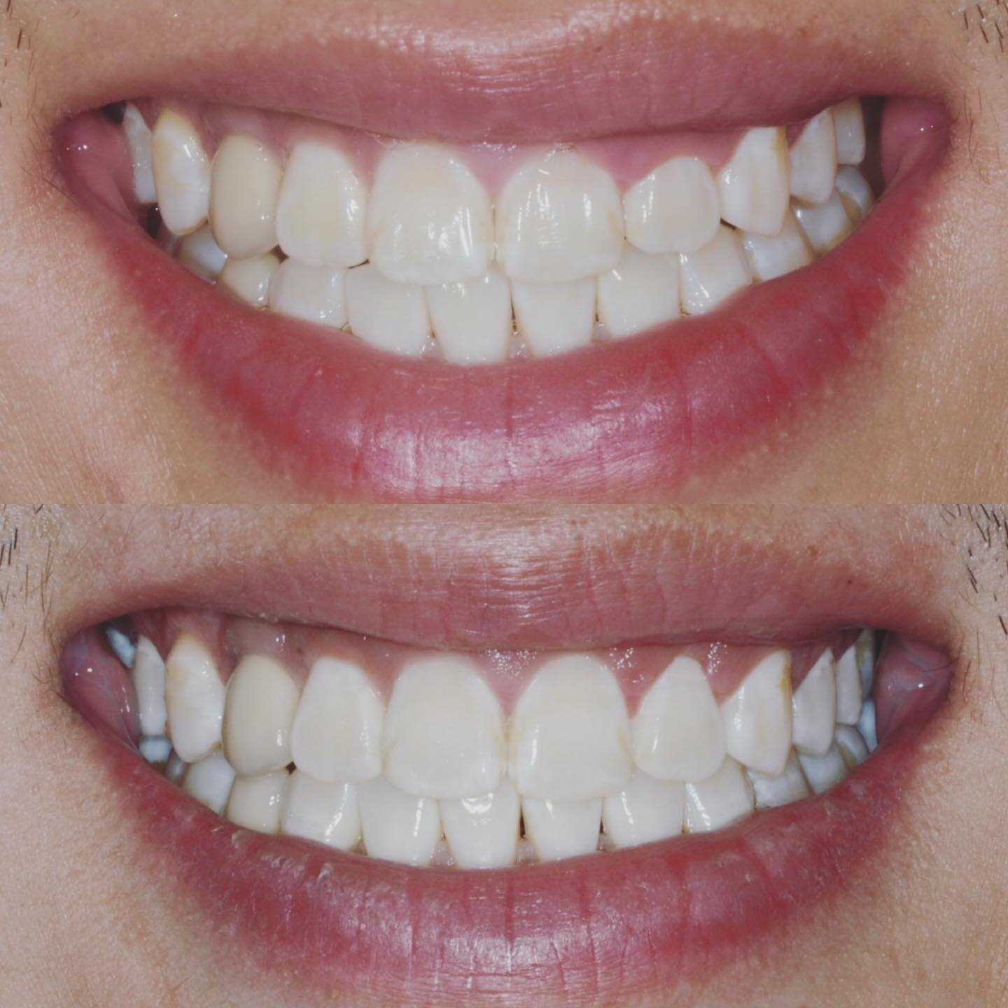 Esthetic Crown Lengthening

Our patient was referred for esthetic crown lengthening (sometime referred to as a gum lift) of the lateral incisor (#10). Although the patient already had a beautiful smile, contouring the tissue and bone (essentially len