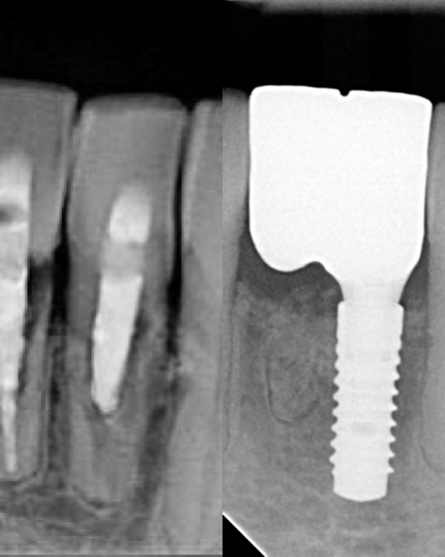 From a hopeless prognosis to a beautiful result! 
Unfortunately both mandibular central incisors (lower front teeth) needed root canal treatment several years ago and later developed resorption - this effectively is a condition whereby the internal a