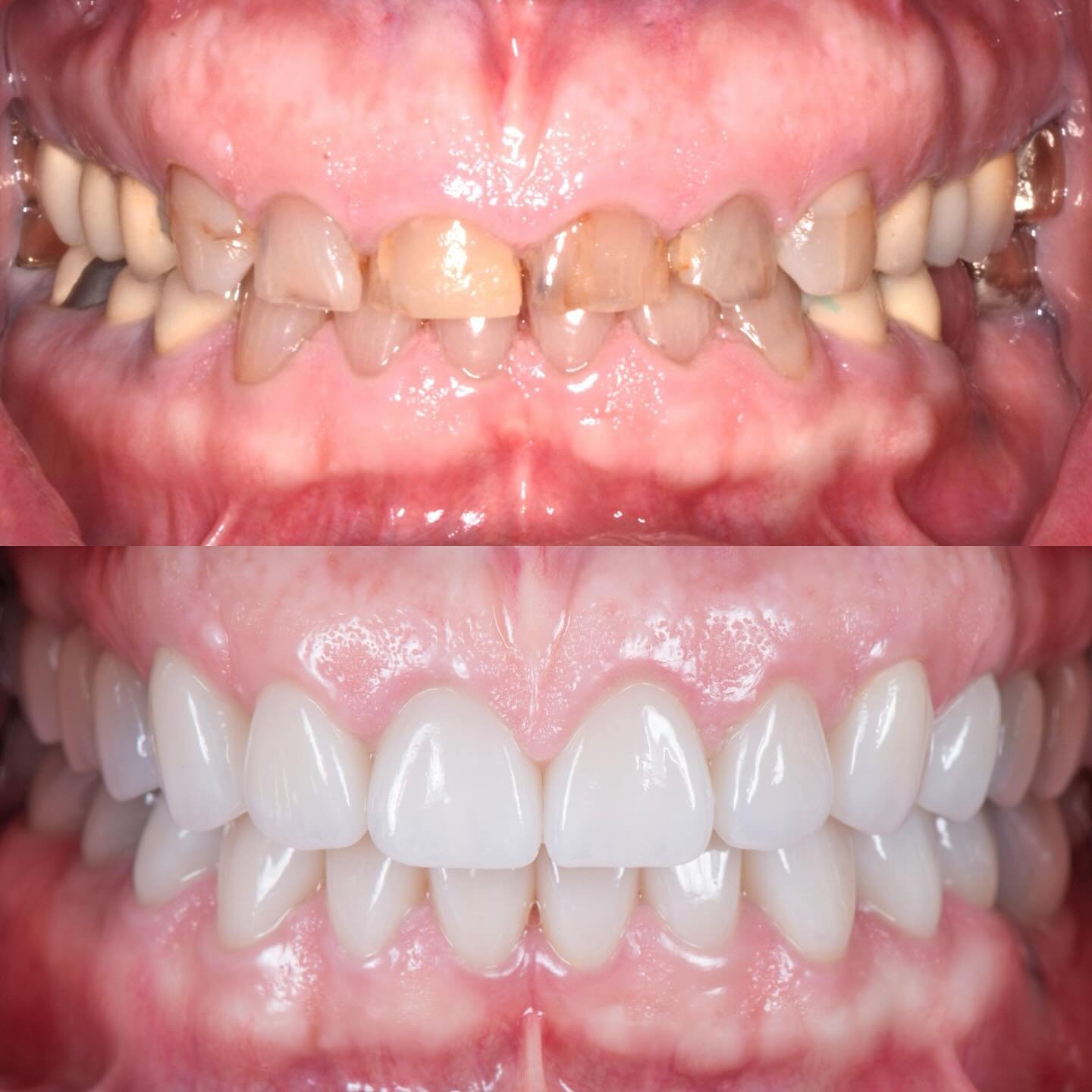 Our patient had a major glow up with a new beautiful, big &amp; confident smile! 😃 Full mouth restoration with porcelain veneers and crowns was completed by her prosthodontist after we performed crown lengthening on #4 - 13 (minus the canines) to ac