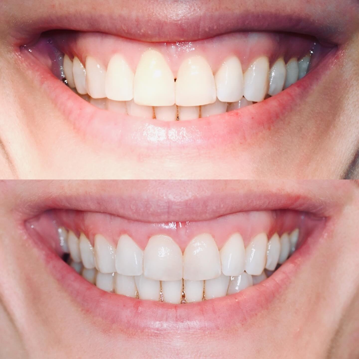 We achieved a beautiful result for a beautiful patient with a bright, stunning smile and high smile line! The after photos were taken 6 weeks post surgery, utilizing a connective tissue graft and emdogain via tunneling and a small vestibular access. 