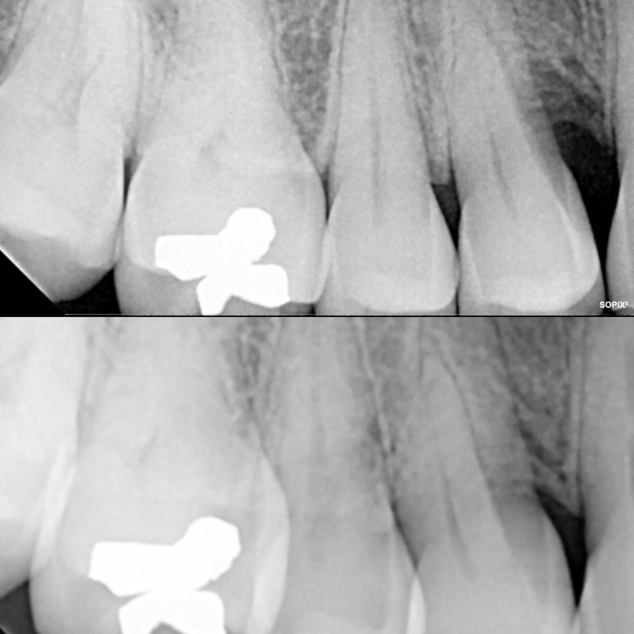 Considerable localized vertical bone regeneration (height ) increase was achieved on our patient on the upper right first premolar (#5) that had fluting, utilizing laser assisted osseous regeneration surgery (LAR) and scaling &amp; root planing with 