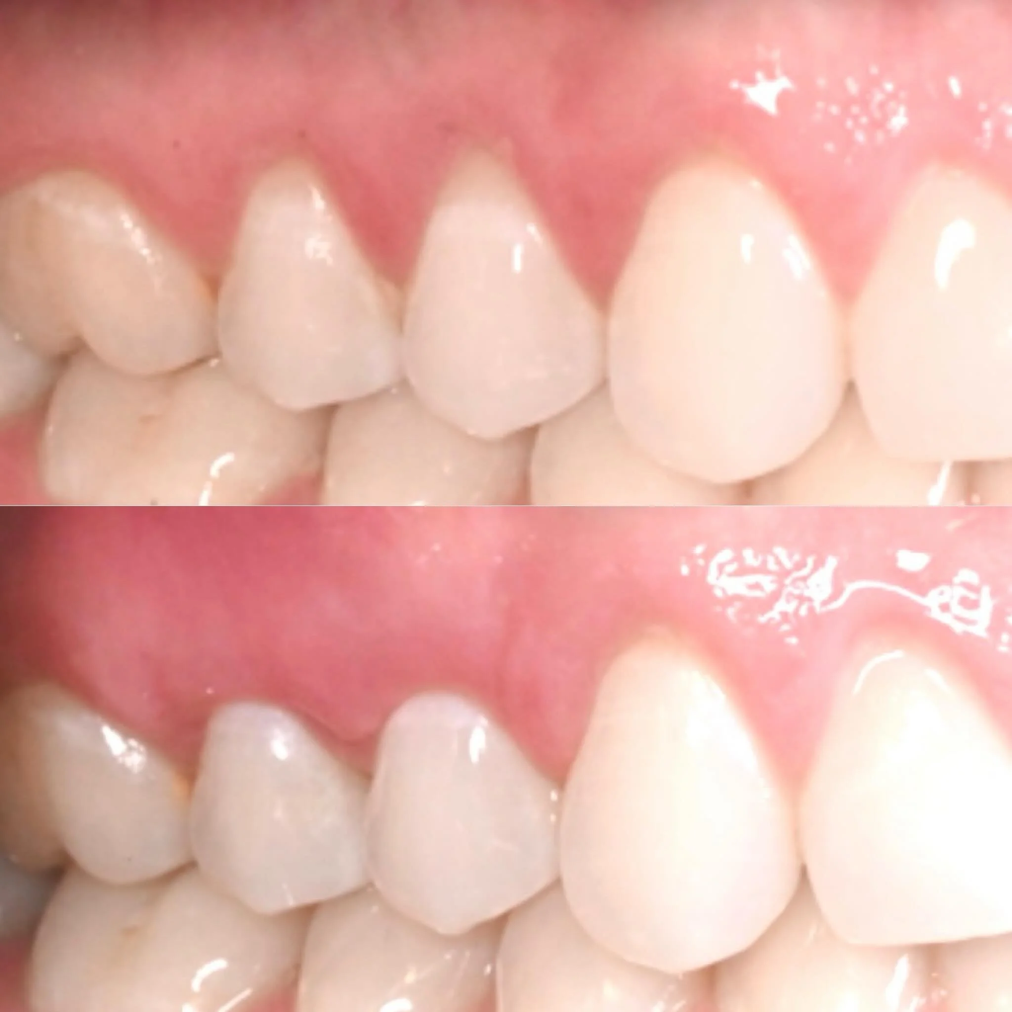 The connective tissue graft on the premolars ( #4 &amp; 5 ) for our patient has healed beautifully since the graft was completed in February, 2026 (post-op photo is April, 2026). Emdogain was utilized during the procedure and a stent used post-operat