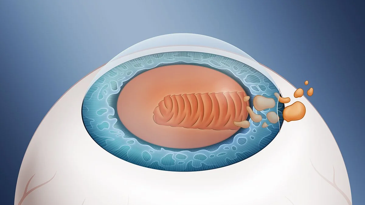 Cataract Feathered.jpg