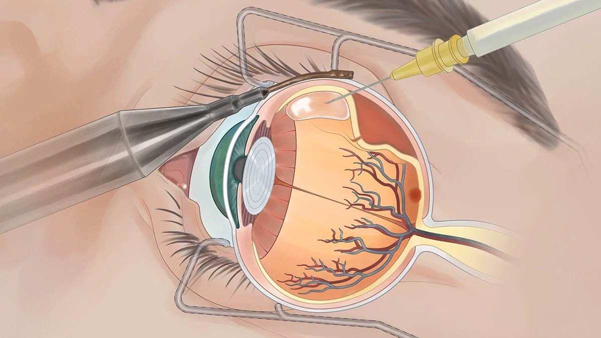 Detatched Retina.jpg