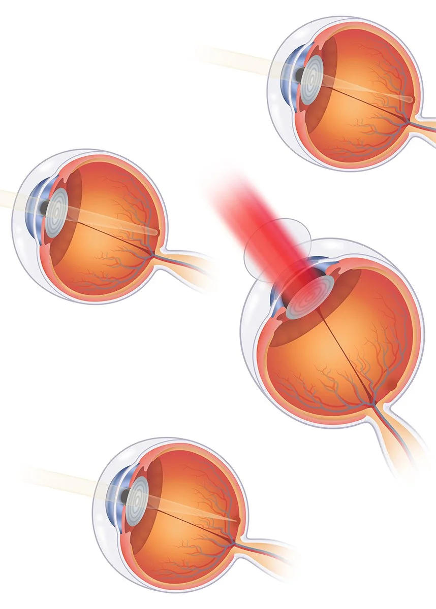 Lasik (Graphical).jpg