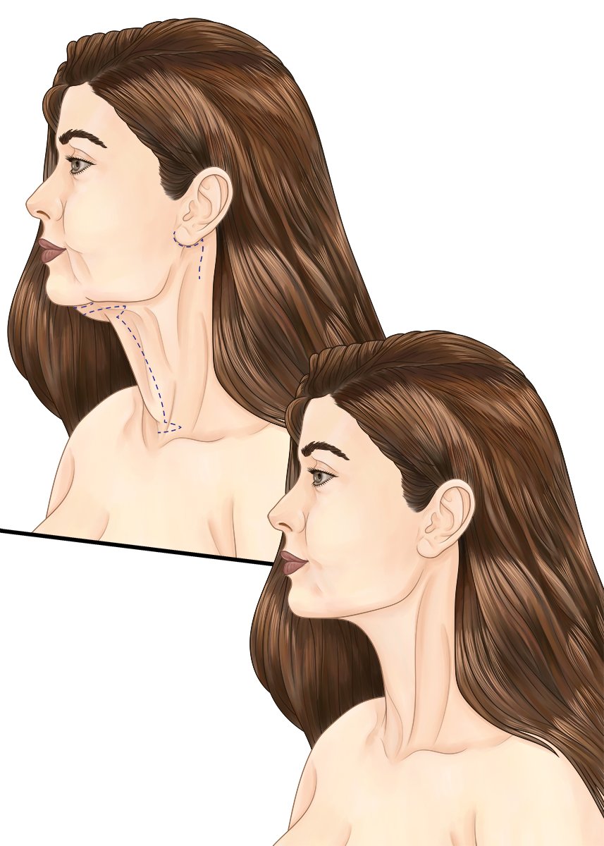 NeckLift.jpg