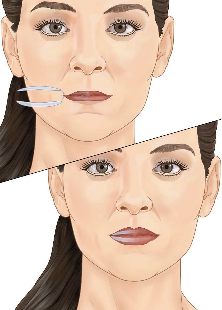 Lip Implants.jpg