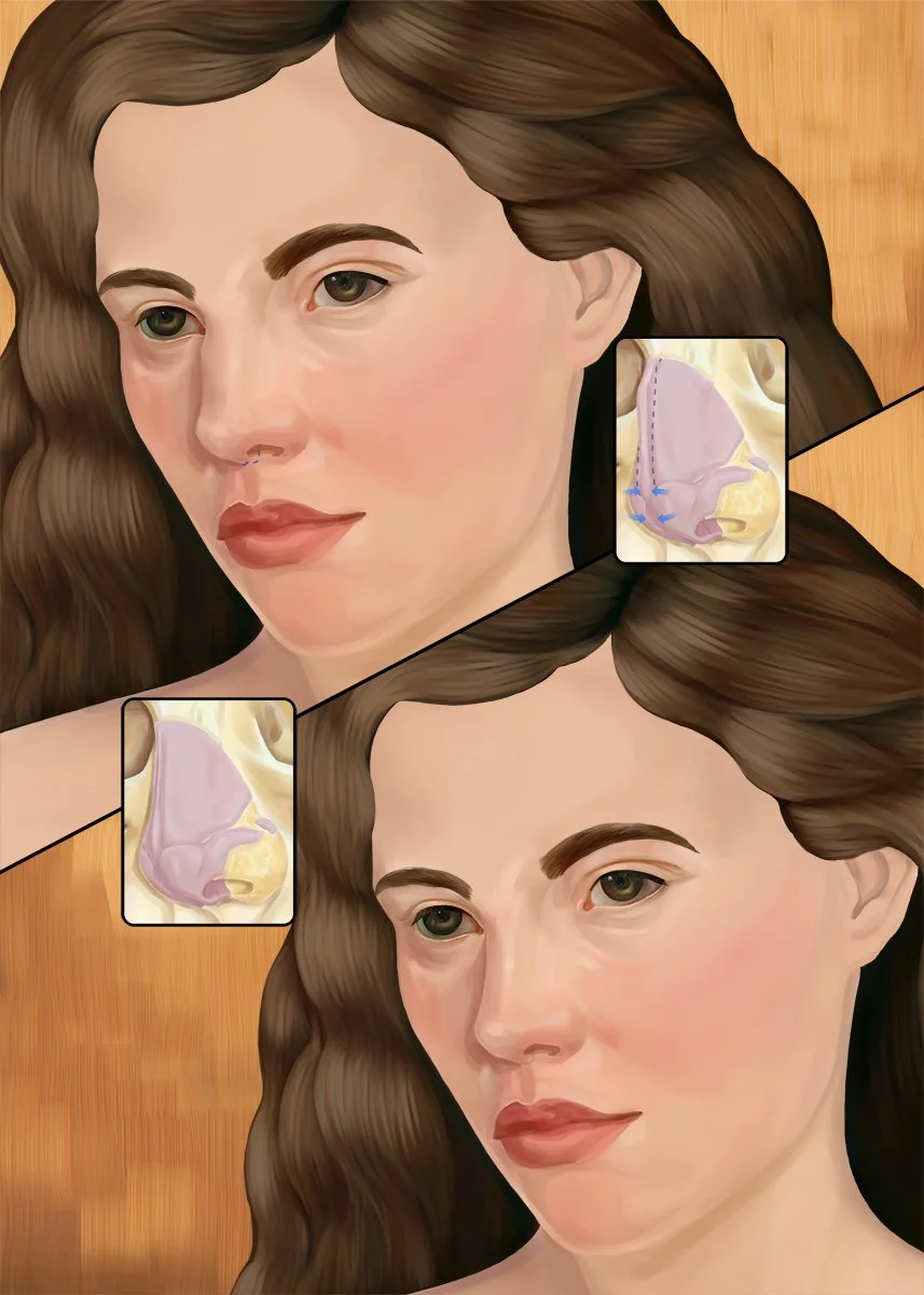 Rhinoplasty (Classical).jpg