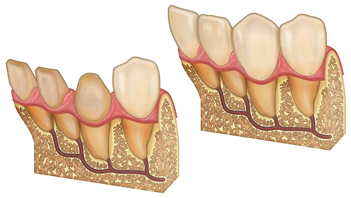 Porc Veneer (Cross).jpg