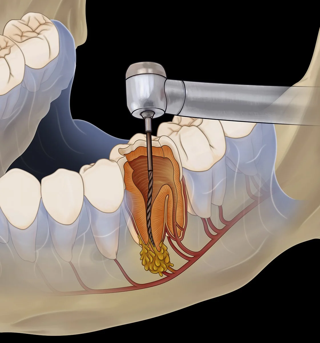 Root Canal (X-Ray).jpg