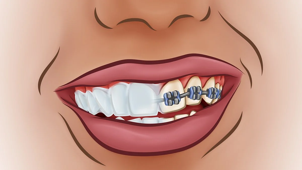 Adult Orthodontia (Feathered).jpg