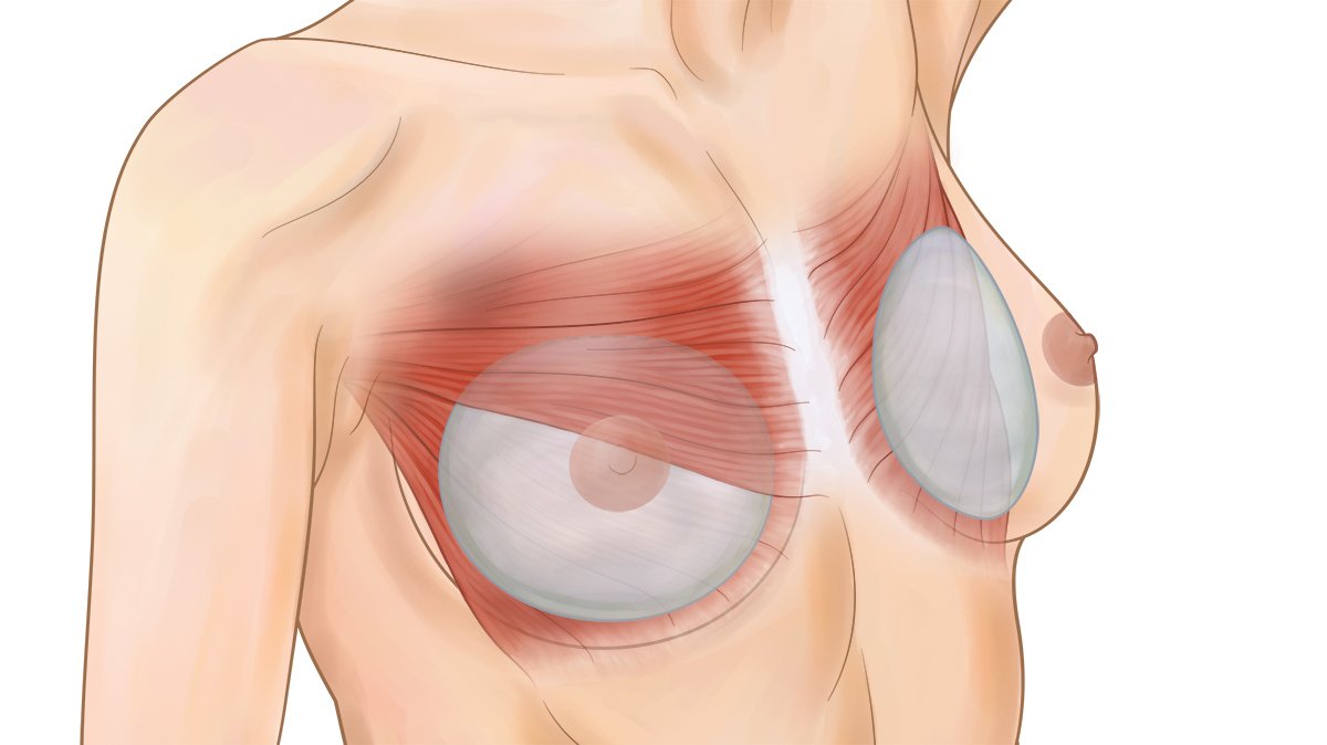 Breast Implant.jpg