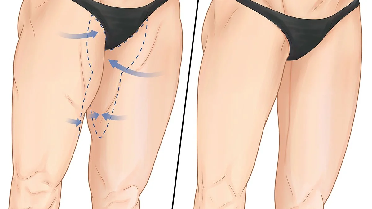 Thigh Lift.jpg