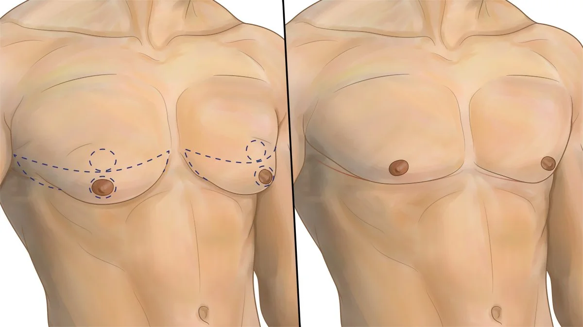 Male Breast Reduction.jpg