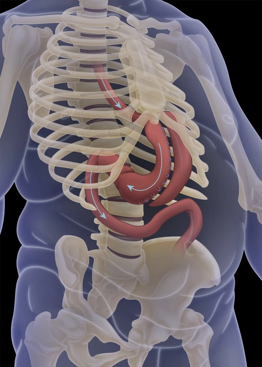 Gastric Sleeve.jpg