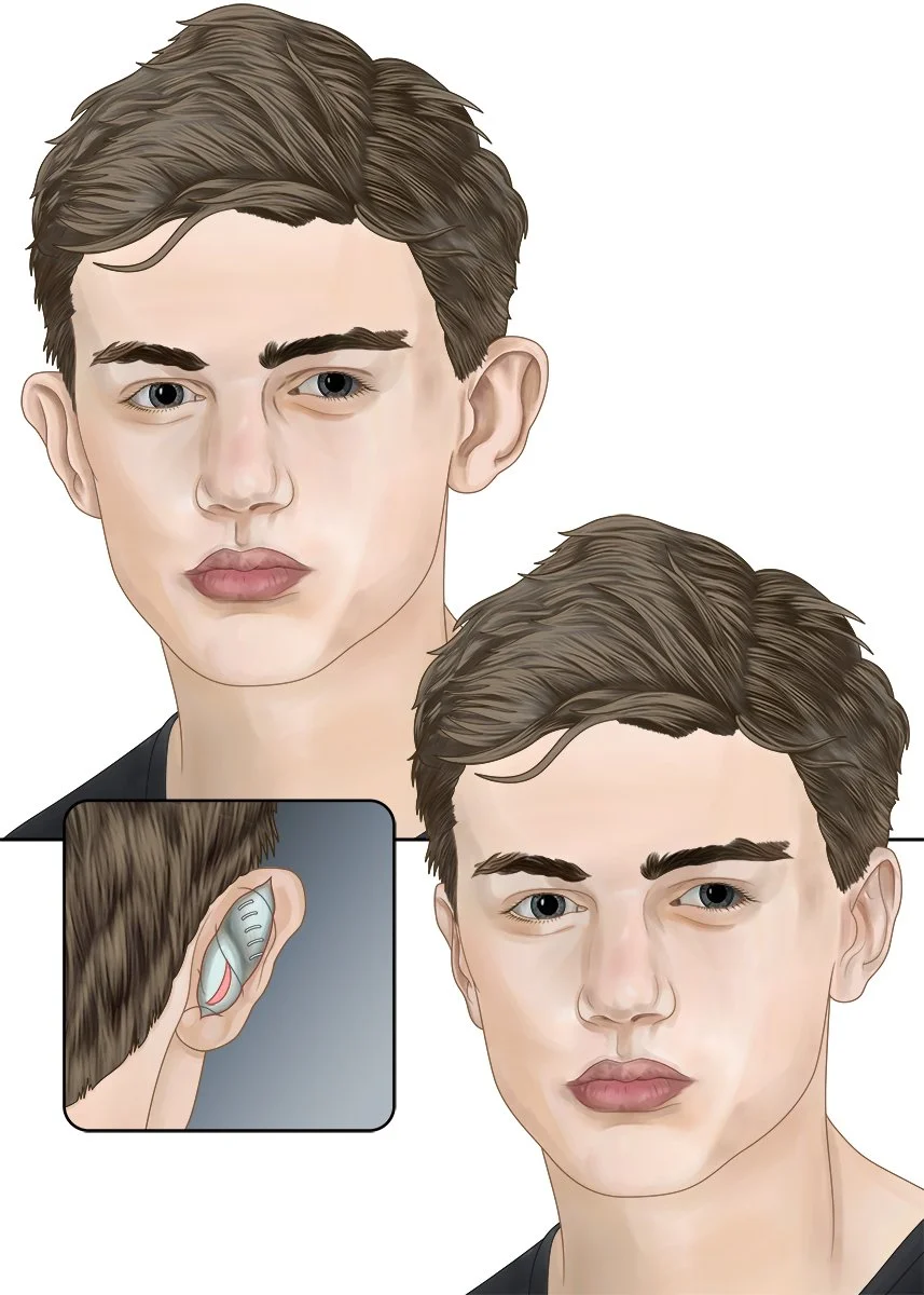 Otoplasty.jpg