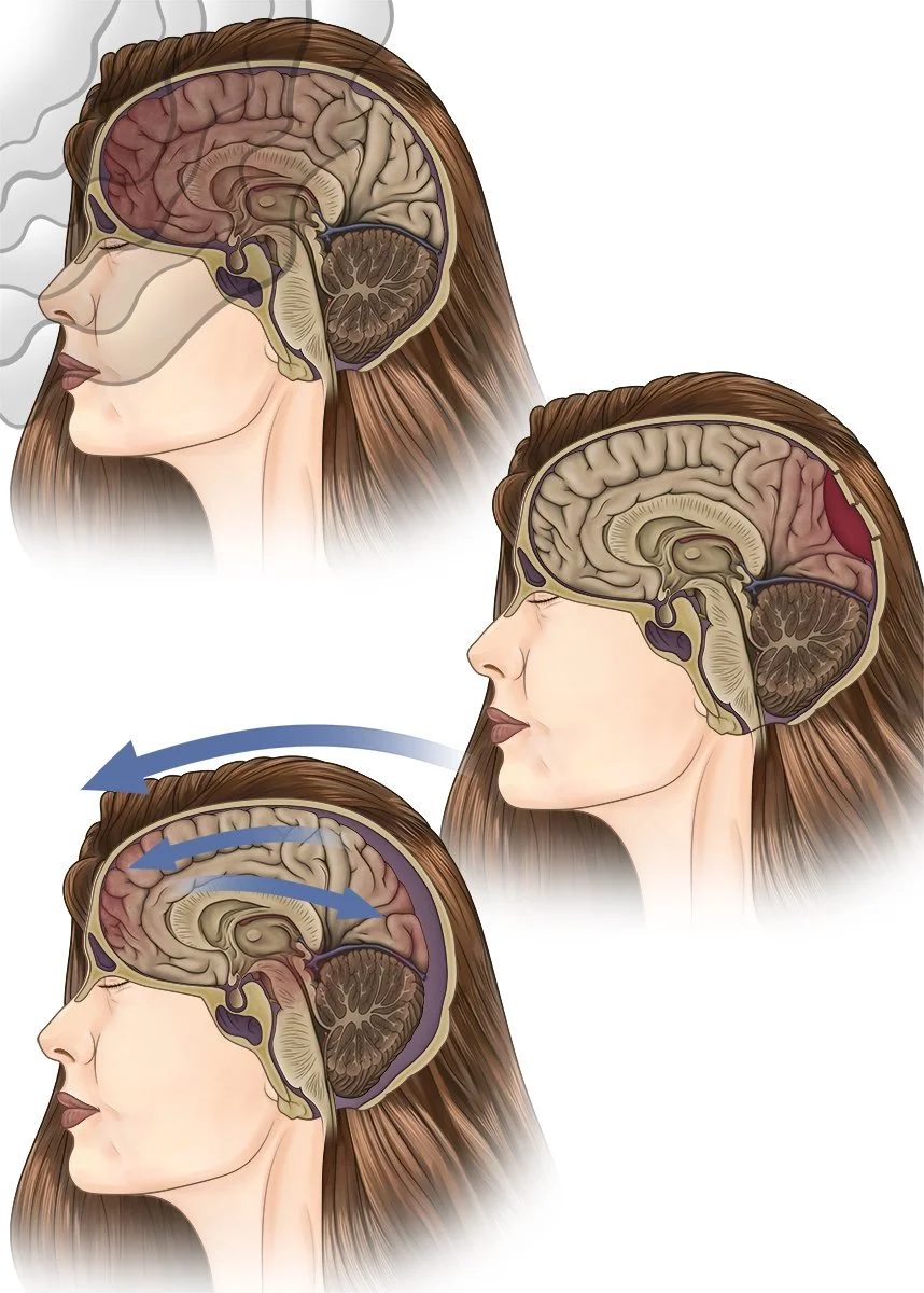 Traumatic Brain Injury.jpg