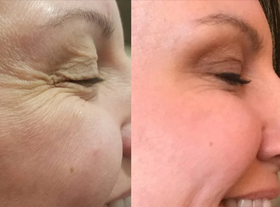 botox.jpg