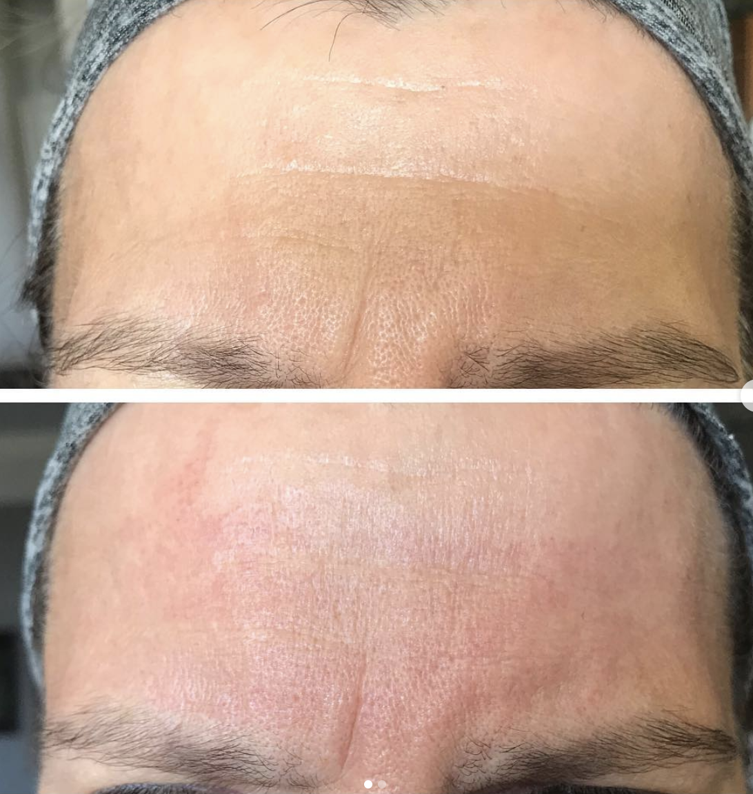 Two treatments, 6 months healed. Deep lines are reduced. Client is relaxed - furrowed brow photo is also posted.