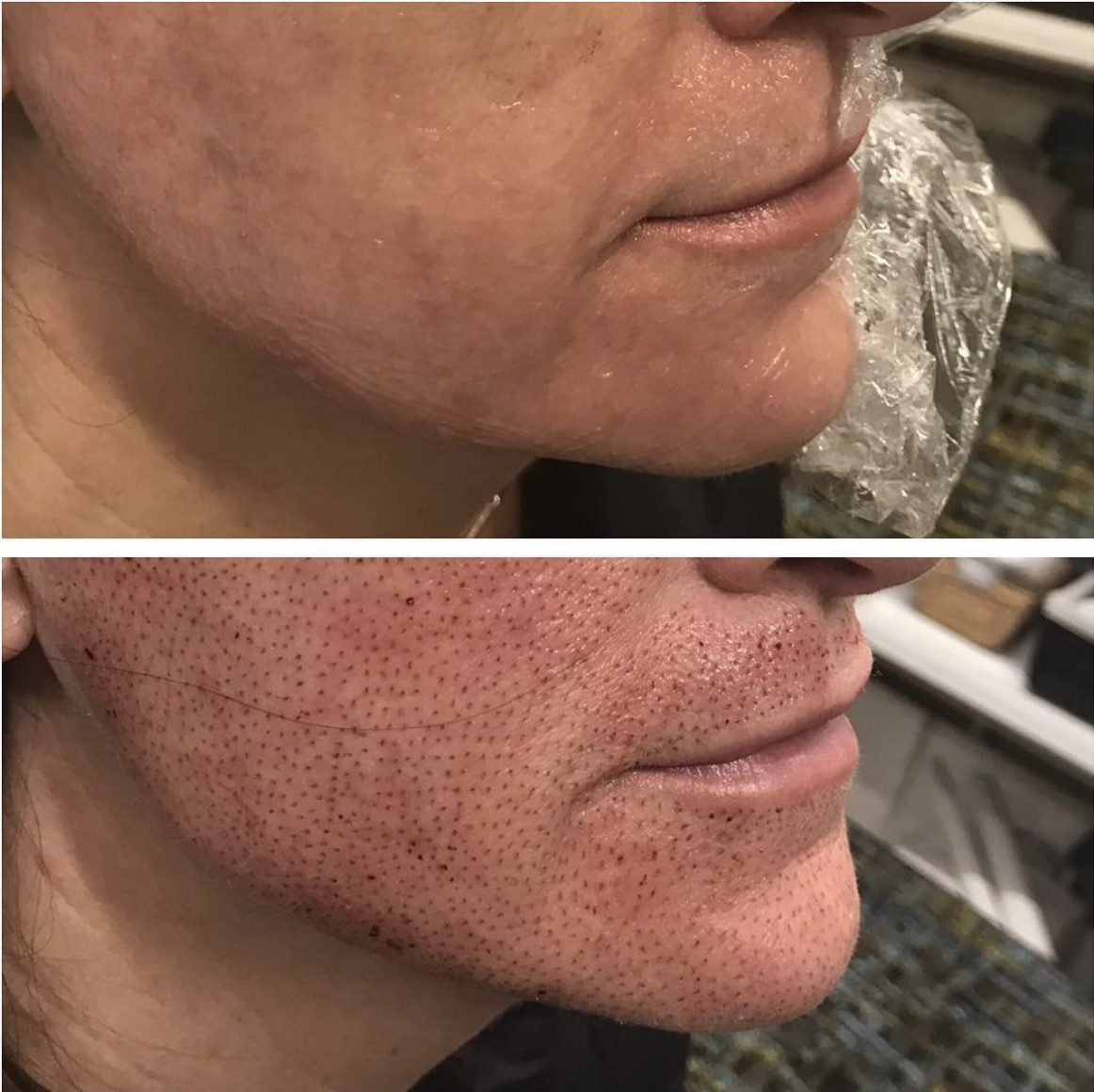 Full Face Lift, immediately post treatment. Jowels are tightened/lifted and corners of mouth are lifted.