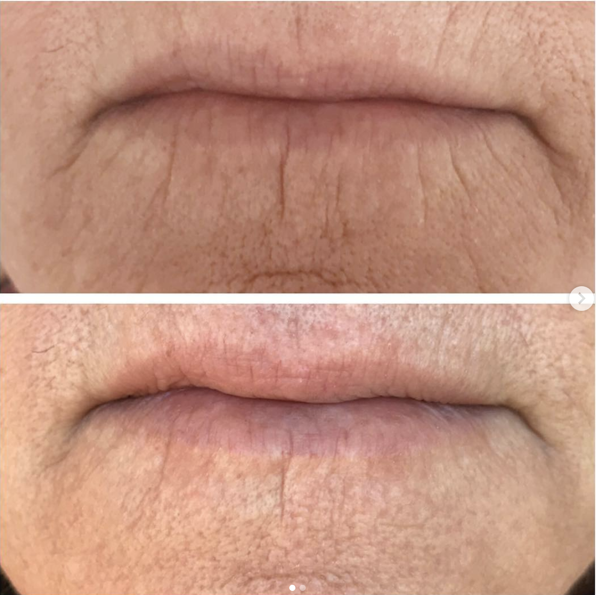 One treatment, 2 months healed. Reduction in fine lines, lift in the corners of mouth and slight lip enhancement (lip flip).