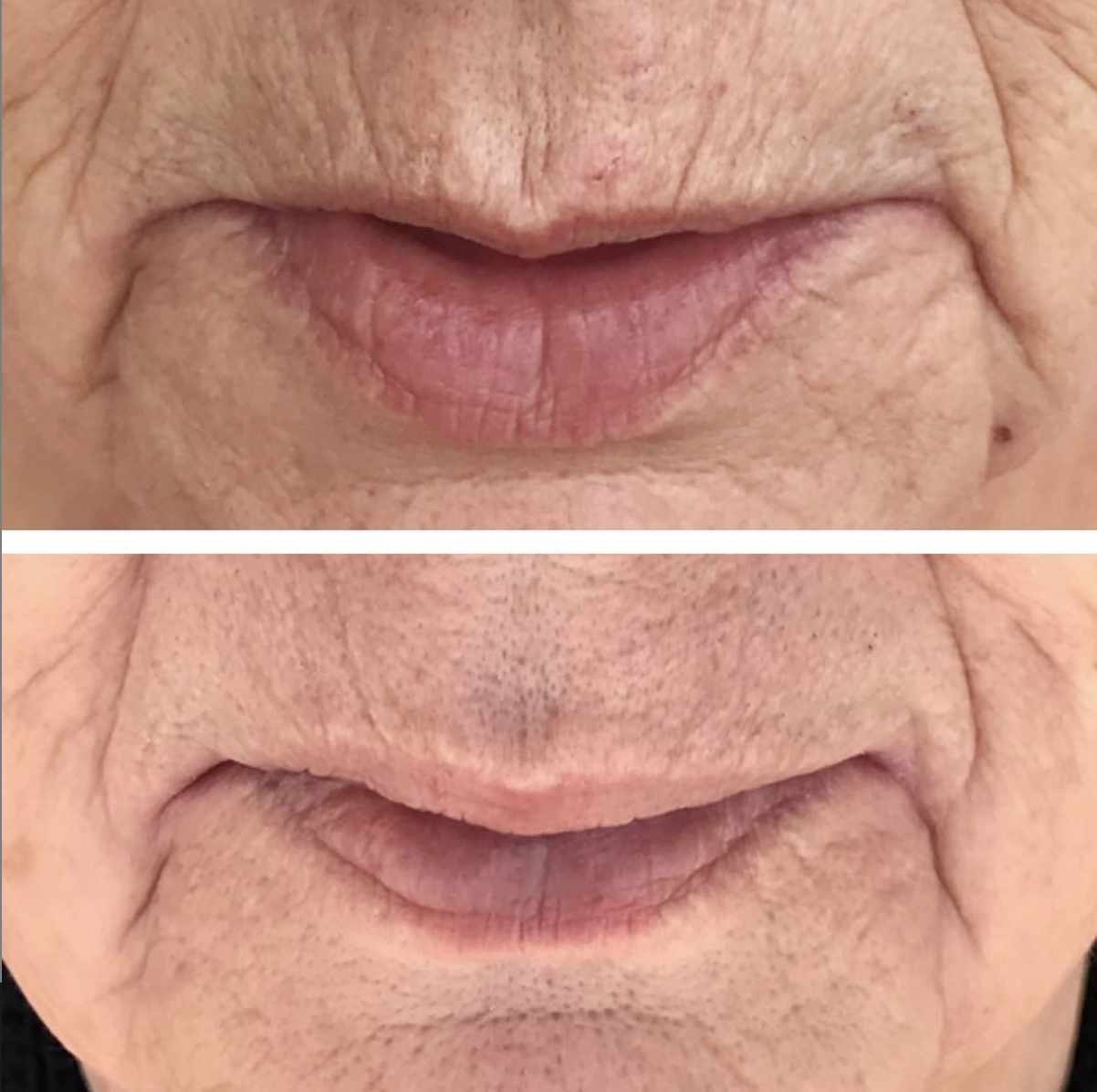 One treatment, 2.5 weeks healed. Reduction of fine lines around the mouth. Deeper wrinkles are shorter and more shallow. Client will continue to see improvements until about 2-3 months post-treatment.