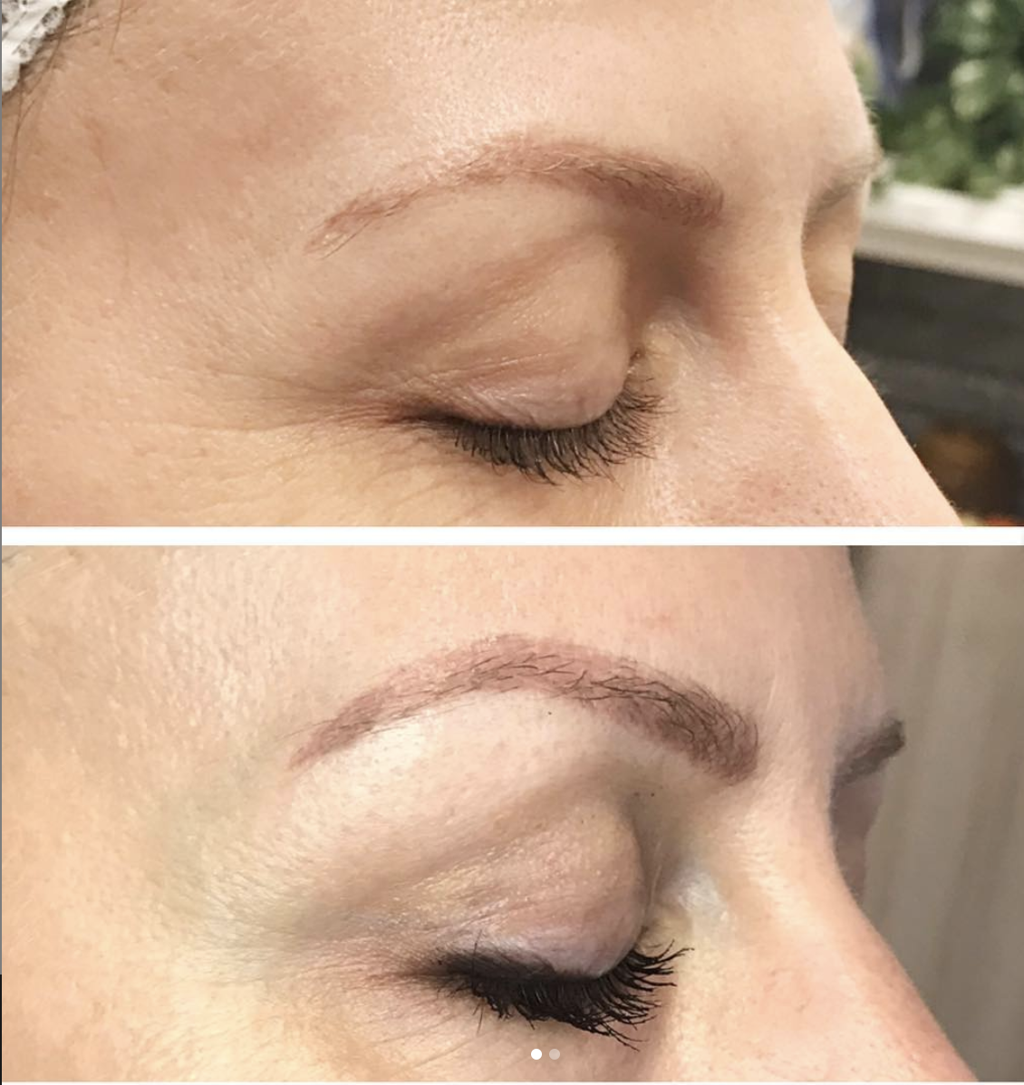 One treatment, 3 months healed. Treated the skin around her eyes and also above her brow for a brow lift and fine-line improvement.