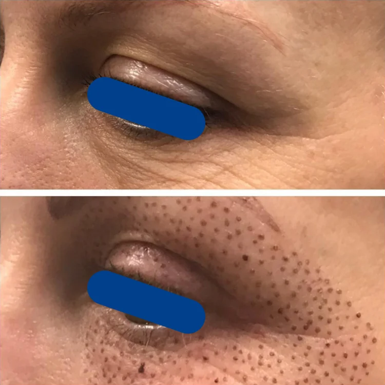 4 days post treatment. 3 months healed photo also posted in this gallery. Client will continue to see improvements for 2-3 months post treatment.