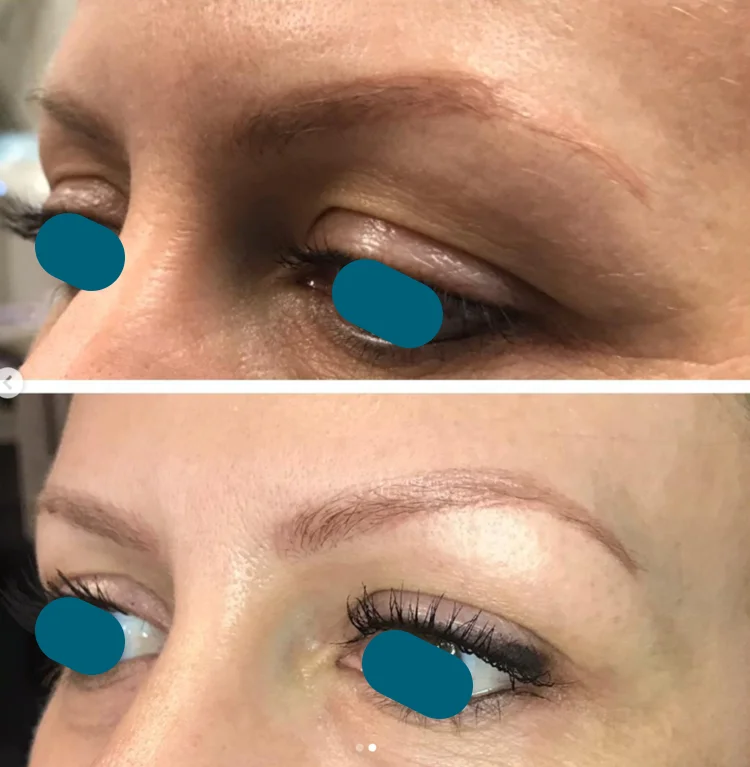 One treatment, 3 months healed. 4 days post treatment photo posted previously. Treated the lids and around the eyes - the crows feet are gone and the eyelid is no longer sagging!